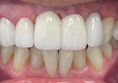 Teeth Whitening WhatsApp Image 2023 09 01 at 13.50.28 3